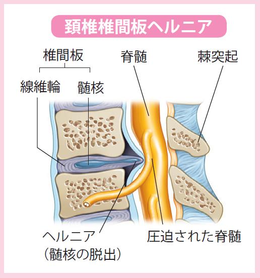 頚椎椎間板ヘルニア