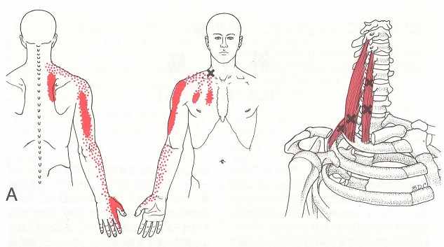 四十肩（五十肩）